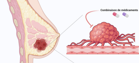 63 cancer du sein 800.jpg